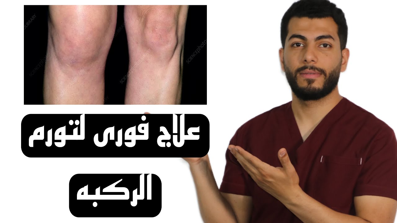تورم الركبة: الأسباب الخفية والعلاج الفعال لتخفيف الألم فوراً!"