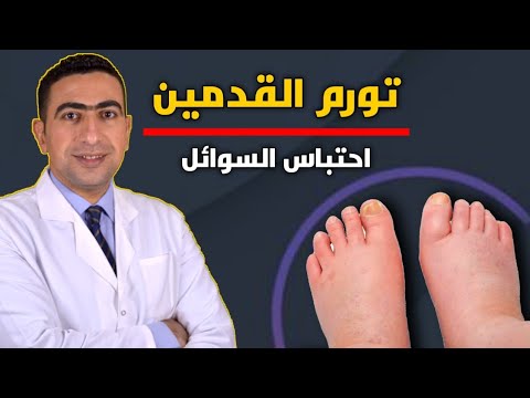 أسباب تورم القدمين واحتباس السوائل في الجسم | سر علاج تورم القدمين وانتفاخهم  بدون أدوية🛡️
