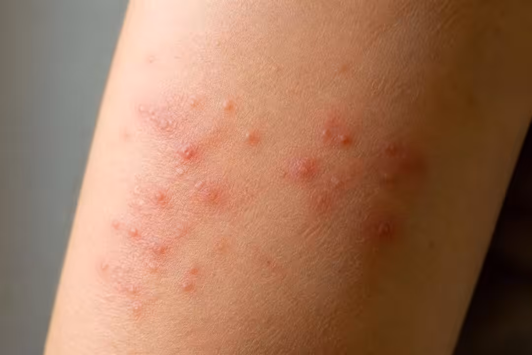 تعرف على شكل الجرب في بدايته والأعراض المبكرة له لتتمكن من اكتشافه وعلاجه بسرعة وفعالية.